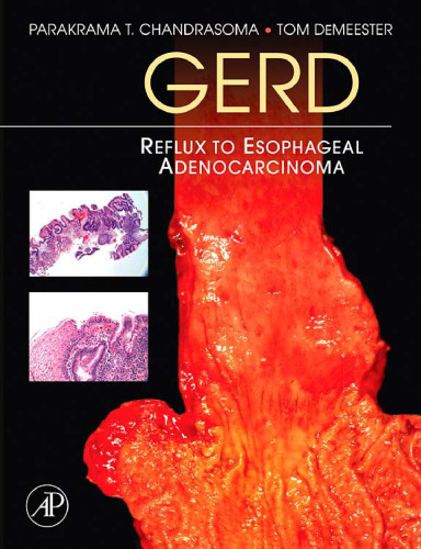 GERD: Reflux to Esophageal Adenocarcinoma