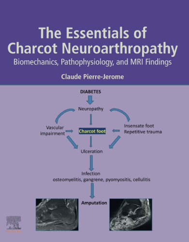 The Essentials of Charcot Neuroarthropathy: Biomechanics, Pathophysiology, and MRI Findings