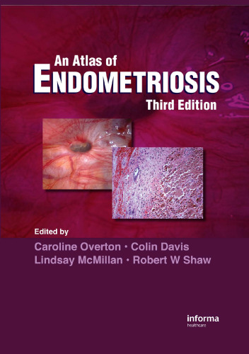 Atlas of Endometriosis,