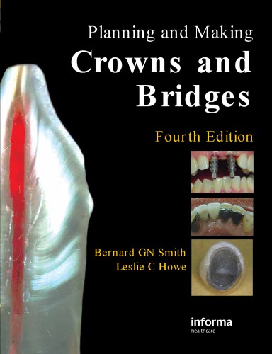 Planning and making crowns and bridges