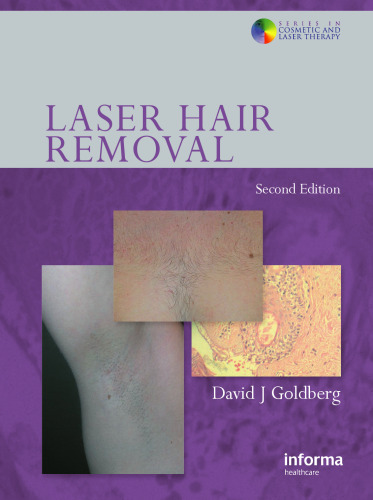 Laser Hair Removal, Second Edition (Series in Cosmetic and Laser Therapy)