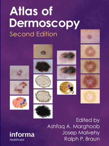 An Atlas of Dermoscopy, Second Edition