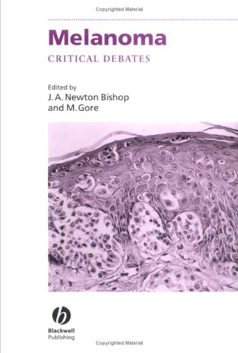 Melanoma: Critical Debates (Challenges In)