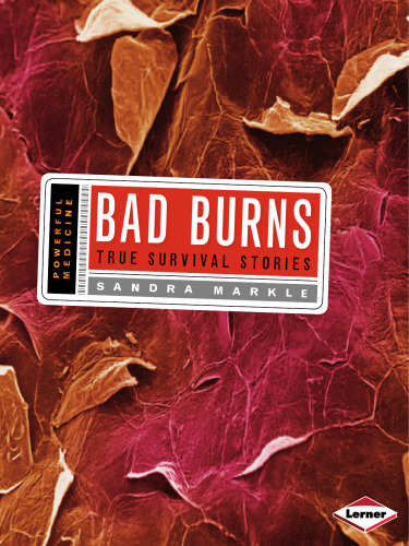 Bad Burns: True Survival Stories