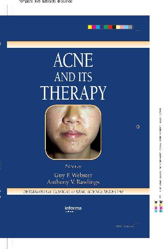 Acne and Its Therapy