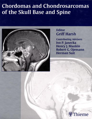 Chordomas and chondrosarcomas of the skull base and spine