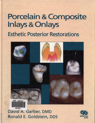 Porcelain & Composite Inlays & Onlays: Esthetic Posterior Restorations