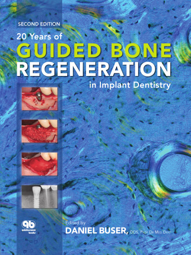 20 Years of Guided Bone Regeneration in Implant Dentistry