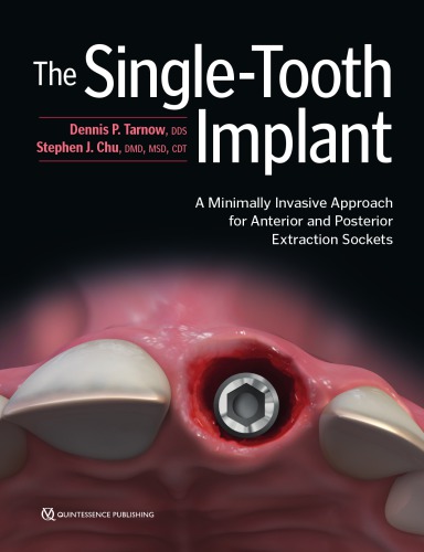 Single-Tooth Implant