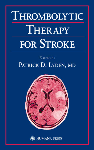 Thrombolytic therapy for stroke