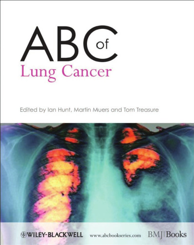 ABC of Lung Cancer (ABC Series)