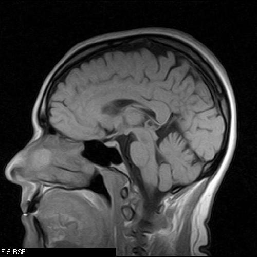 Quantitative MRI of the Brain Measuring Changes Caused by Disease