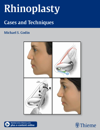 Rhinoplasty - Cases and Techniques