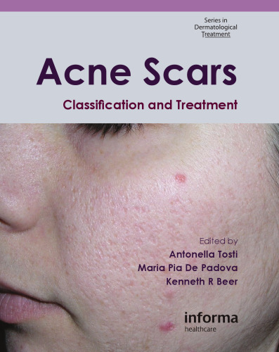 Acne Scars: Classification and Treatment (Series in Dermatological Treatment)