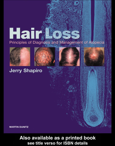 Hair Loss: Principles of Diagnosis and Management of Alopecia