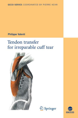 Tendon transfer for irreparable cuff tear (Collection GECO)