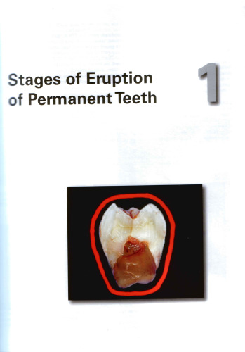Clinical Success in Surgical And Orthodontic Treatment of Impacted Teeth