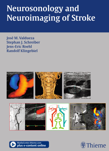 Neurosonology and Neuroimaging of Stroke Book / DVD