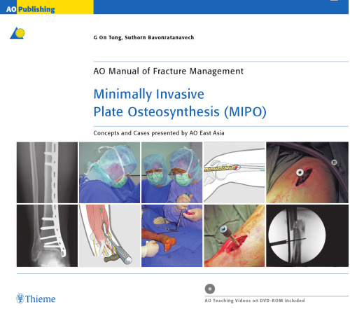 Minimally Invasive Plate Osteosynthesis (MIPO)