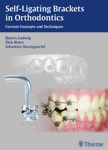 Self-ligating Brackets in Orthodontics: Current Concepts and Techniques