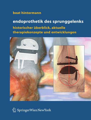 Endoprothetik des Sprunggelenks: Historischer Überblick, aktuelle Therapiekonzepte und Entwicklungen (German Edition)