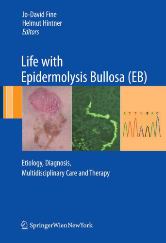 Life with Epidermolysis Bullosa (EB): Etiology, Diagnosis, Multidisciplinary Care and Therapy