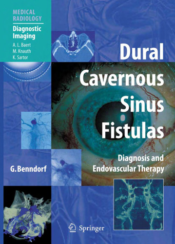 Dural Cavernous Sinus Fistulas: Diagnosis and Endovascular Therapy (Medical Radiology Diagnostic Imaging)