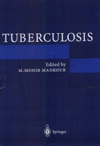 Tuberculosis