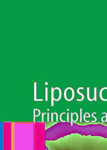 Liposuction: Principles and Practice