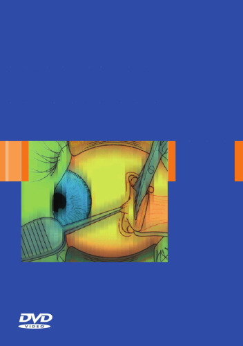 Strabismus Surgery and its Complications