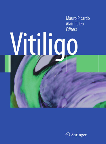 Vitiligo