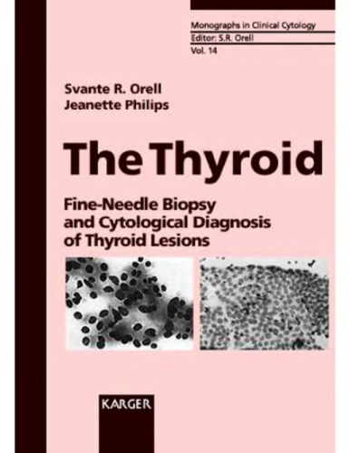 The Thyroid: Fine-Needle Biopsy and Cytological Diagnosis of Thyroid Lesions (Monographs in Clinical Cytology)
