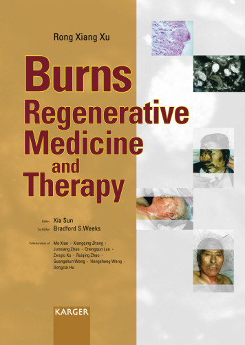 Burns regenerative medicine and therapy