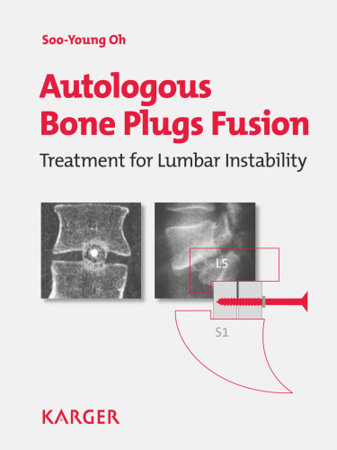 Autologous Bone Plugs Fusion: Treatment for Lumbar Instability: 3E Criteria Technical Operative Notes The Functioning of the Oh's Screw