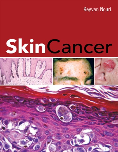 Skin cancer.