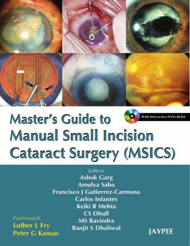 Masters Guide to Manual Small Incision
