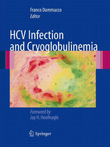 Hcv Infection and Cryoglobulinemia