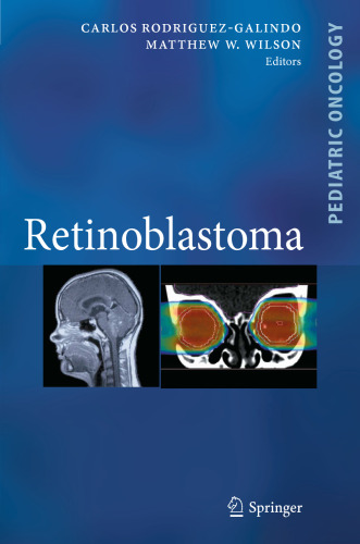 Retinoblastoma