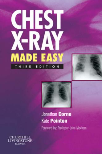 Chest x-ray made easy