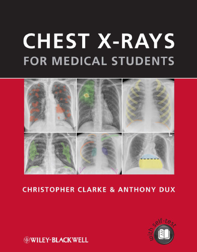 Chest X-rays for Medical Students