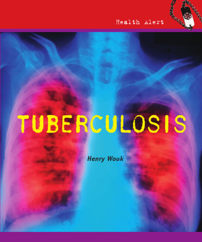 Tuberculosis