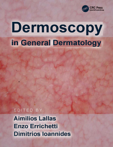 Dermoscopy in general dermatology