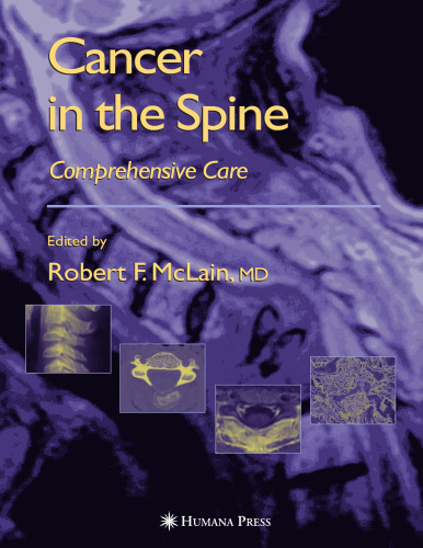 Cancer in the Spine: Comprehensive Care
