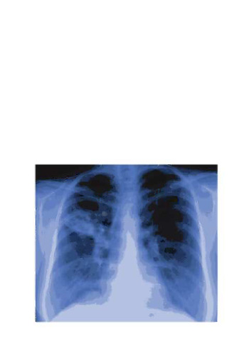Bronchial Asthma: A Guide for Practical Understanding and Treatment