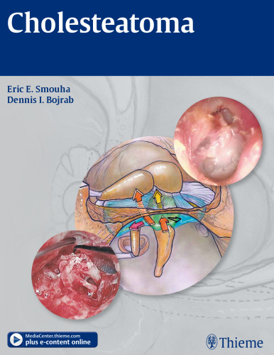 Cholesteatoma