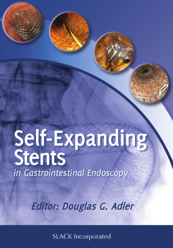 Self-Expanding Stents in Gastroenterology