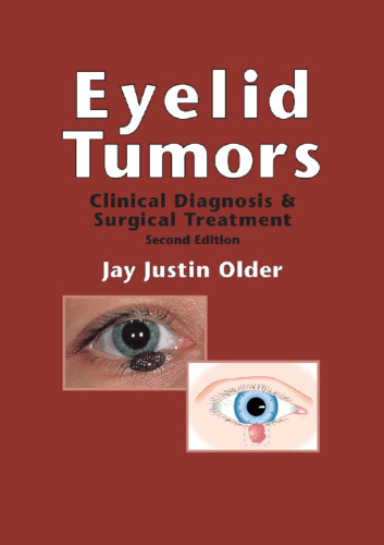 Eyelid Tumors