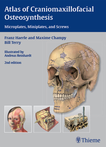 Atlas of Craniomaxillofacial Osteosynthesis: Microplates, Miniplates,and Screws