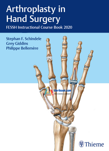 Arthroplasty in Hand Surgery 1st Edition 2021