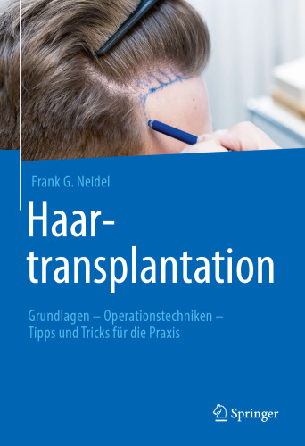 Haartransplantation: Grundlagen - Operationstechniken - Tipps und Tricks für die Praxis